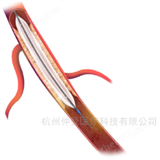 廠家供美敦力外周血管約束型球囊擴(kuò)張導(dǎo)管